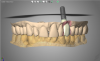 Fig 9. Implant in place digitally.