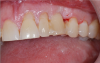 Fig 12. The patient's previous tooth bonded into place.