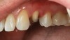 (3.) Maxillary premolar preparation.