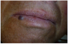 Figure 4 Preoperative view of the capillary hemangioma of the lip. The lesion is a 5-mm x 5-mm round, slightly exophytic nodule with a smooth surface and is bluish-purple in color.