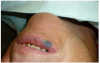 Figure 5 Topical anesthetic was applied prior to administering local anesthesia.