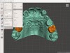 Fig 6. Digital model showing teeth to be extracted.