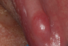 Figure 2. Oral Fibroma caused by an ill-fitting denture Courtesy of Dentalcare.com