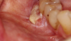 Figure 6. Squamous Cell Carcinoma Courtesy of Dentalcare.com