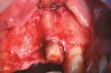 Figure 1  Full-thickness flap reflection exposed the left lateral incisor, which was fractured and intruded apically beyond the alveolar housing.