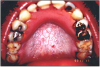 Figure 2. Nicotine Stomatitis. Image source: www.doctorspiller.com