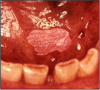 Figure 3. Leukoplakia Under Tongue. Image source: www.doctorspiller.com