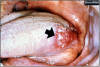 Figure 4. Squamous Cell Carcinoma of the Tongue. Image source: www.brown.edu