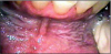 Figure 5. Leukoplakia at Chewing Tobacco Site. Image source: www.doctorspiller.com