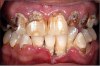 Figure 13. Oral Condition of a Crystal METH Abuser. “METH Mouth” Image source: www.doctorspiller.com