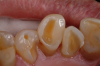 Fig 4. Worn dentition.