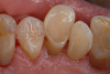 Fig 5. Dentition repaired.