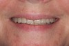 Fig 1. Preoperative smile view. The patient wanted to straighten her maxillary teeth and change the shade and shape from No. 4 through No. 13.
