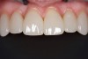 Fig 4. Postoperative intraoral view of ZLS veneers after cementation.