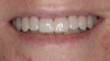 Fig 5. Postoperative smile view of ZLS veneers after cementation.