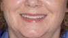 Fig 6. Postoperative facial view of ZLS veneers after cementation. Images and case courtesy of Christopher Joy, DMD; Palo Alto, California.