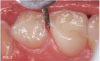 Fig 2. Surfaces trimmed; caries lesions exposed.