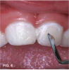 Fig 6. Much plaque accumulation; no oral home care apparent.