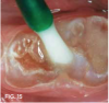 Fig 15. Fluoride varnish applied once SDF blotted.