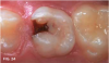 Fig 24. 12-year-old patient had no tooth sensitivity 6 months after SDF application, and tooth exfoliated a few months later.