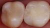 Fig 2. With knowledge and experience in composite resin restorations, longevity can be increased, postoperative sensitivity decreased, and desired esthetics achieved.