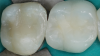 Fig 6. Bulk-fill composite resin for posterior restoration.