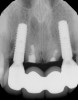 Fig 19. Radiograph 3 years postoperative of Nos. 7 through 10 implant restoration described in Fig 17 and Fig 18.