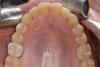 Figure 7. Seated screw-retained crown with screw access hole closed.
