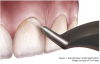 Figure 1. Supragingival nozzle application. Image courtesy of Hu-Friedy.