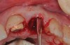 Fig 6. The 3-mm buccal gap was grafted tightly with low-substitution DBBM, and a pouch was created as a mini full-thickness flap to accept a connective tissue graft.
