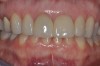 Fig 9. Completed crowns at 5 years, front view. Implant No. 9 was screw-retained (periodontist: Robert A. Levine, DDS; restorative dentist: Zola Makrauer, DMD).