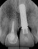 Fig 12. Periapical radiograph at 5 years.