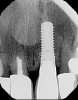 Fig 15. Periapical radiograph of No. 9 at 11-year follow-up of patient in Fig 14.