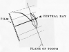 Figure 15 - Maxillary Central/Lateral Incisors