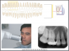 Figure 22 - Maxillary Premolars