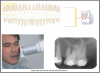 Figure 25- Maxillary Molars