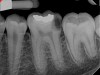 Figure 6. Preoperative radiograph of carious exposure on tooth No. 19. Courtesy of Dr. Mohammed A. Alharbi.