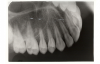 Figure 72 - Posterior Oblique Maxillary Occlusal Image