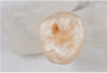 Fig 15. ICDAS code 5: Carious dentin visible in less than half of the occlusal table.