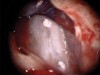 Figure 16. Post apicoectomy. Courtesy of Dr. Sam Kratchman.