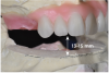 Fig 5. Bone reduction model surgery performed in mandibular arch to create 13 mm to 15 mm of inter-occlusal space required for the mandibular All-on-4 provisional restoration.