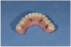 Fig 9. Restoration-driven implant placement—Optimal implant position and distribution is achieved as a result of using the provisional prosthesis guide.