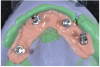 Fig 14. Soft tissue model—Surgical impression modified by adding a silicone material around the attached implant analogues before pouring the zero expansion stone for master cast fabrication.