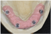 Fig 15. Master cast with soft-tissue model fabricated from the surgical impression provides a working model for the indirect denture conversion technique.