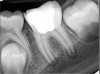 Figure 13. Tooth was asymptomatic at 1-year follow-up. Courtesy of Dr. Guillaume Jouanny.
