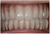 Fig 20. Patient intraoral condition 3 years following delivery of maxillary and mandibular All-on-4 definitive prosthesis.