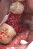Fig 5. Bone graft placed in the socket.