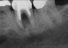 Fig 15. (Case 3) Radiograph of tooth No. 19, which had a hopeless prognosis.