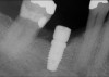 Fig 23. Implant inserted in a regenerated ridge after 6 months healing.