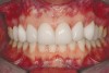 Fig 6 (and Fig 7). Prerestorative orthodontics was completed in 5 months. Final result 3 years, 4 months after completion.